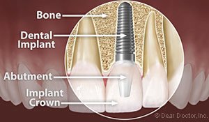 Dental Implants Monroe, MI